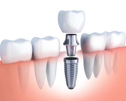 Trồng răng implant là gì? Tại sao trồng răng implant lại là lựa chọn hàng đầu?