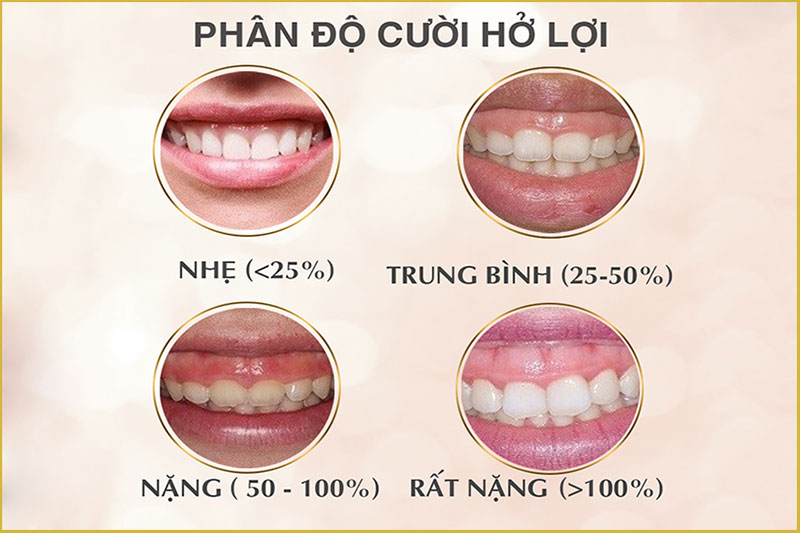 cuoi-ho-loi-co-nieng-rang-duoc-khong-2