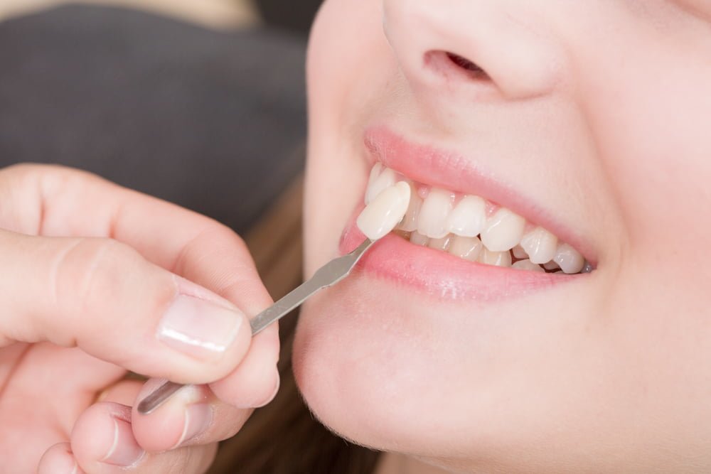 Cải thiện hình dáng răng