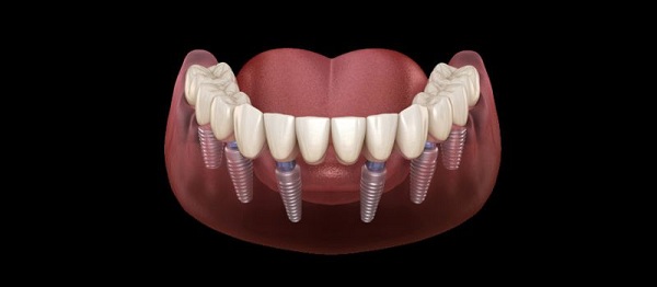Cấy Ghép Implant All on 6: Khôi phục vấn đề răng với 6 Implant